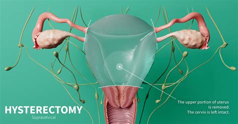 Types of hysterectomy | Complete Anatomy