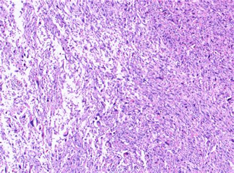 Histology revealing Trojani Grade 3 myxofibrosarcoma of the left buttock | Download Scientific ...