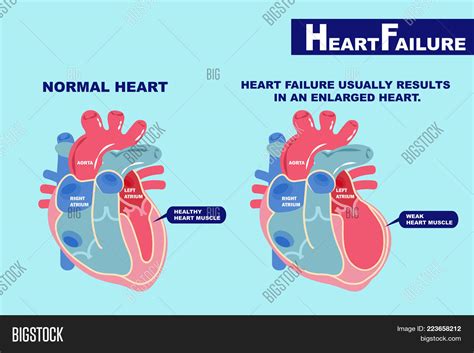 Cartoon Heart Failure Vector & Photo (Free Trial) | Bigstock