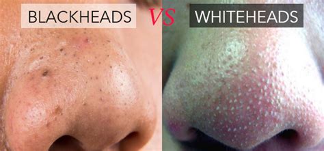 Dr Rachel Ho | Whiteheads-vs-Blackheads