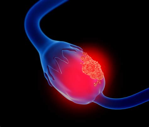 What’s new in biomarker testing for ovarian cancer | Contemporary OB/GYN