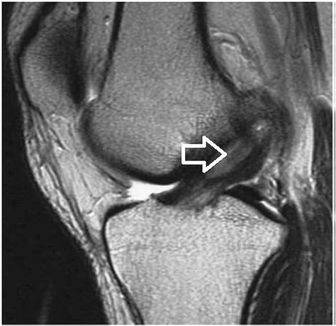 Cureus | Anterior Cruciate Ligament Ganglion Cyst and Mucoid Degeneration: A Review