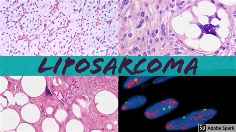 Liposarcoma 101: Everything a Pathologist Needs to Know - YouTube