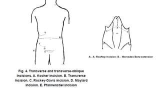 abdominal incision.pptx