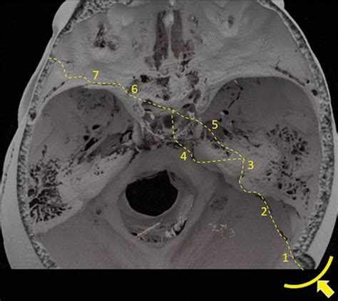 Fracture Petrous Pyramid