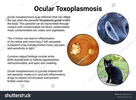 Ocular Toxoplasmosis Disease Caused By Singlecelled Stock Illustration 2280916573 | Shutterstock