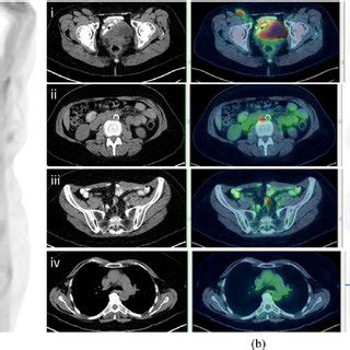 A 55-year-old female referred for radiotherapy to presumed Stage 1... | Download Scientific Diagram