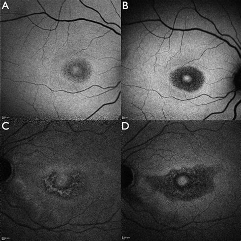 Progression of retinal pigment epithelium alterations visualised with... | Download Scientific ...