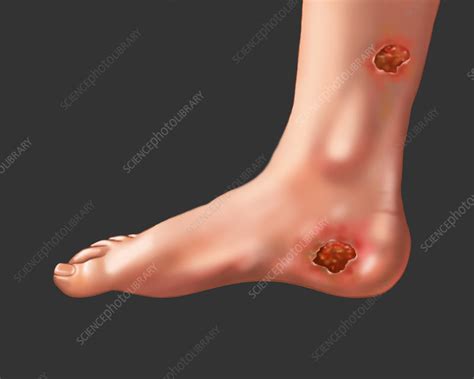 Bed Sores - Stock Image - F031/6991 - Science Photo Library