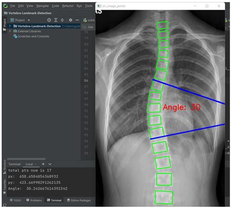 Diagnostics | Free Full-Text | Automated Cobb Angle Measurement for Adolescent Idiopathic ...