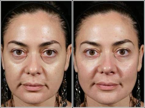 Instant treatment of Dark circles or bags under eyes through dermal fillers