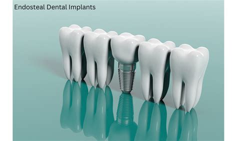 What Are Endosteal Dental Implants? - Woodcrest Dental Associates