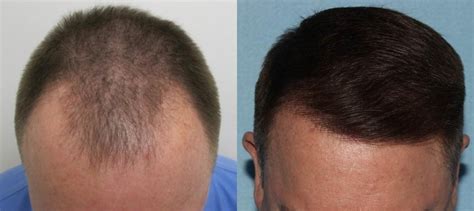 SmartGraft Hair Transplant Before & After Photo Gallery | Houston, TX | DermSurgery Associates