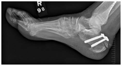 life after a calcaneus fracture surgery - Jonas Higdon