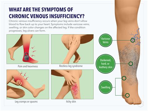 Lower Extremity Venous Reflux