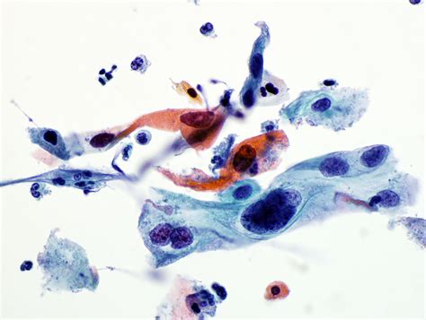 Fig. 8.20 Squamous cell carcinoma | University of Wisconsin–Madison