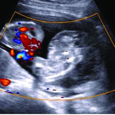 Image of the acardiac twin with reverse flow from the pump twin ...