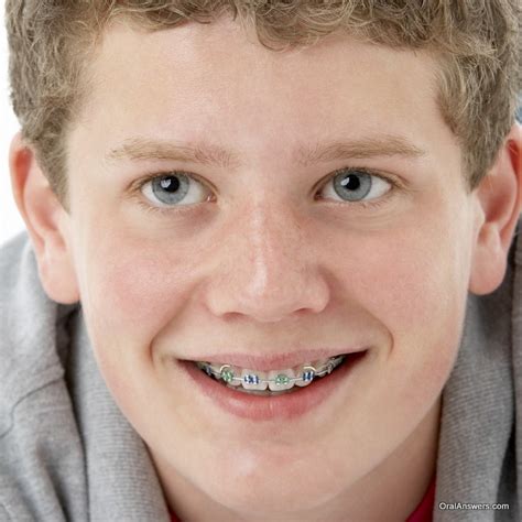 60 Photos of Teenagers with Braces - Robweigner's blog