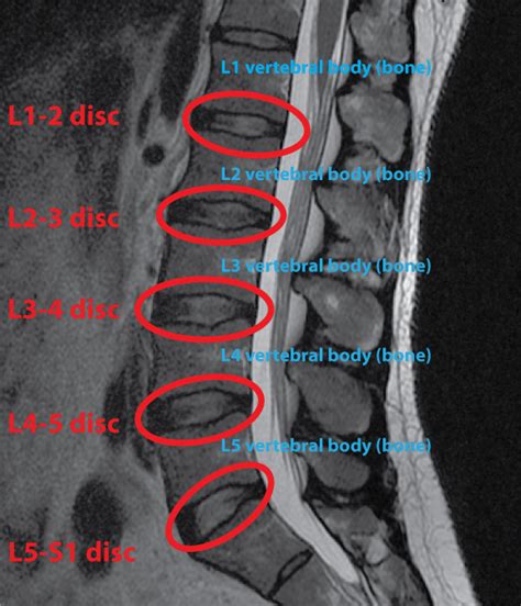 [성신여대한의원]MRI를 통하여 살펴보는 요추의 해부학적 구조 - Sagittal plane : 네이버 블로그