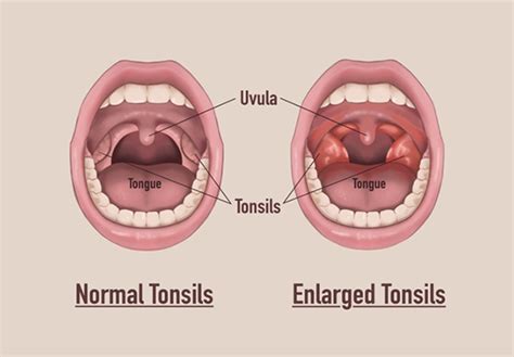 Tonsillectomy & Adenotonsillectomy | KidsHealth NZ