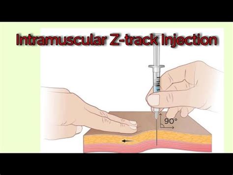 Intramuscular Z-track Injection - YouTube