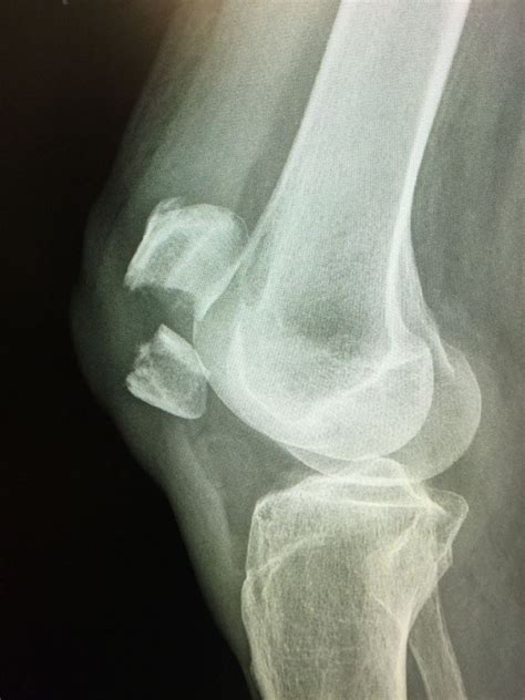 Patella fracture: Mechanism of injury, signs and symptoms and treatment ...