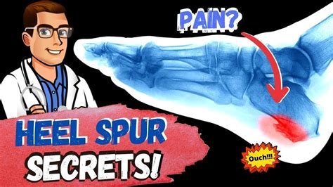 BEST Heel Spur Treatment [Heel Spur Removal, Stretches & Massage!] - YouTube