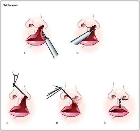 Chin liposuction side effects critica, types of flaps in plastic ...