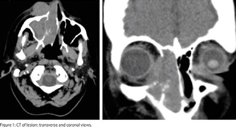 Figure 1 from Chronic dacryocystitis ? | Semantic Scholar