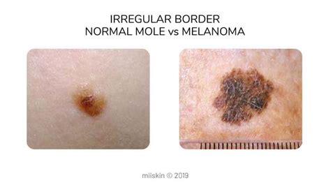 Normal Mole Vs Melanoma