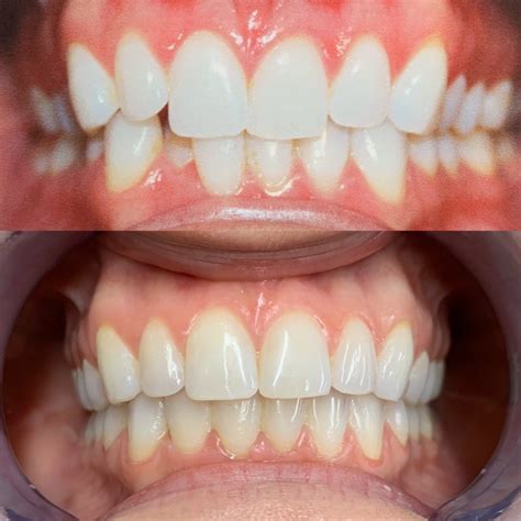 Invisalign Before And After | Firouz Orthodontics - West Los Angeles