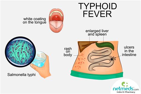 Typhoid: Causes, Symptoms And Treatment | Netmeds