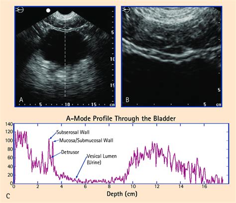 (A) A B-mode ultrasound image of a bladder in a transverse section... | Download Scientific Diagram