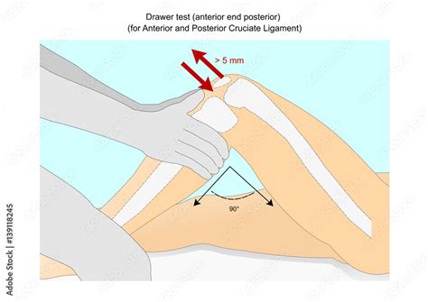 Posterior Drawer Test