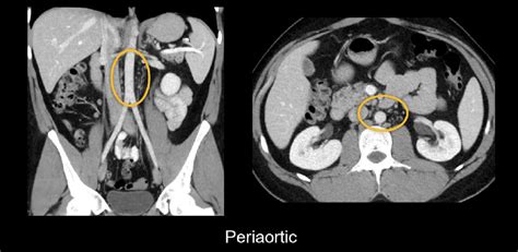 Abdominal CT: lymph nodes • LITFL • Radiology Library