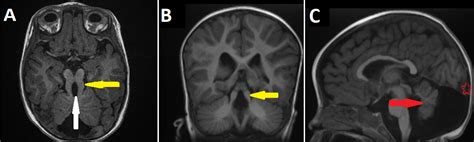 Dandy Walker Malformation Mri