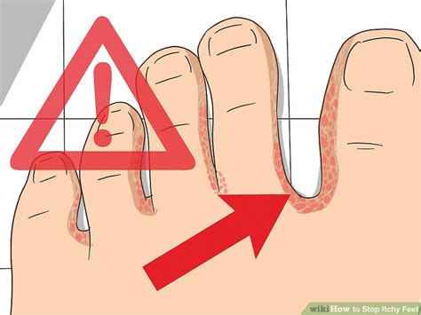 3 Ways to Stop Itchy Feet - wikiHow