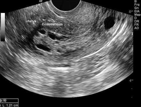 WK 3 L 2 SAME UT NOW TRANSVAGE Endometrial hyperplasia | Radiology ...