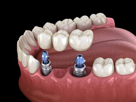 Dental Implant Supported Bridge Birmingham - St. Paul's Square Dental