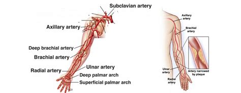 Arm artery disease treatment in chennai