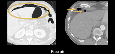 Abdominal CT: peptic ulcer perforation • LITFL • Radiology Library