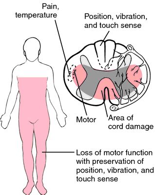 anterior cord syndrome Neurology A post-traumatic spinal cord symptom complex characterized by a ...