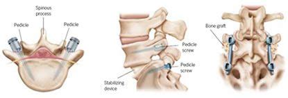 Transforaminal Lumbar Interbody Fusion (TLIF) Diagnosis and Treatment