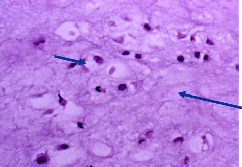 Enchondroma Histology