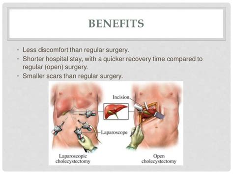 Open cholecystectomy vs laparoscopic cholecystectomy