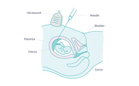 Is chorionic villus sampling dangerous? - NIPT by GenePlanet