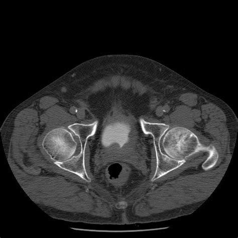 Transitional cell carcinoma CT - wikidoc