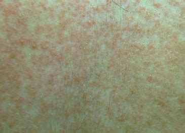 Maculopapular Rash - Pictures, Treatment, Symptoms, Causes | Health Momma