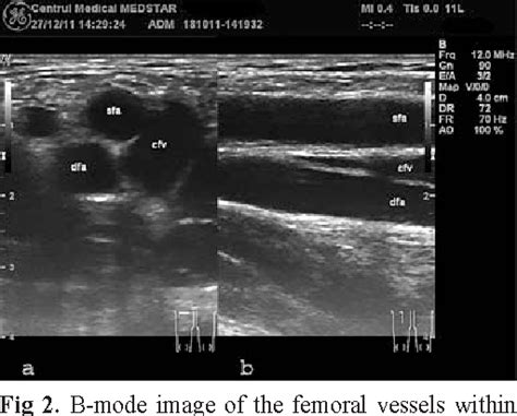 Deep Femoral Artery Ultrasound