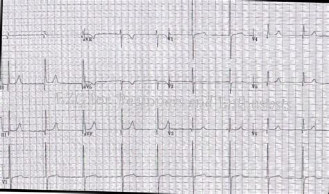 Dextrocardia | ECG Guru - Instructor Resources